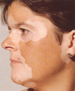 vitiligo_0101