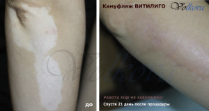 Витилиго