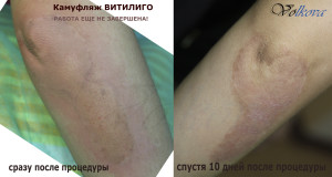 витилиго2