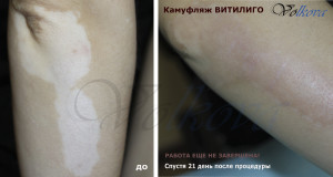 Витилиго