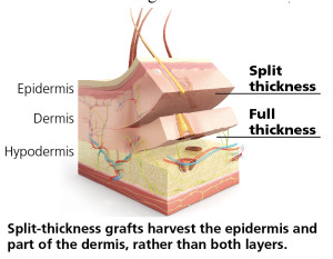 split-thickness
