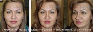 пластика
