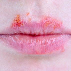 285x285_HIV_Mouth_Sores_Infections_8