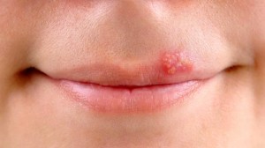 BGHT113_lips-cold-sore-prevention_FS