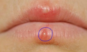 Fluid-filled-bumps-on-lower-lip