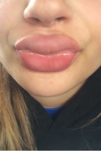 Kylie-Jenner-Lips-Challenge