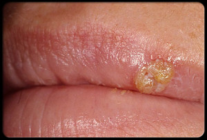 coping-with-cold-sores-s6-oozing-cold-sore