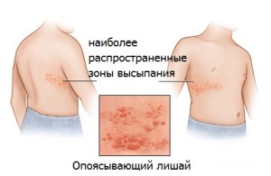 Как-лечить-опоясывающий-лишай