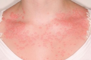 1071116_urticaria-rash-upper-chest-female-16